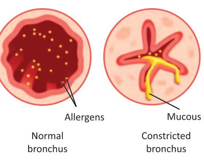 Fig 2.10: Asthma
