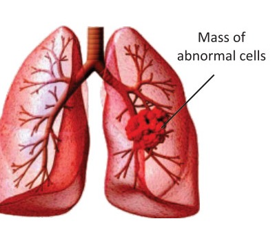 Fig 2.11: Lung Cancer