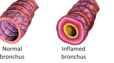 Fig 2.7: Normal and inflamed bronchi