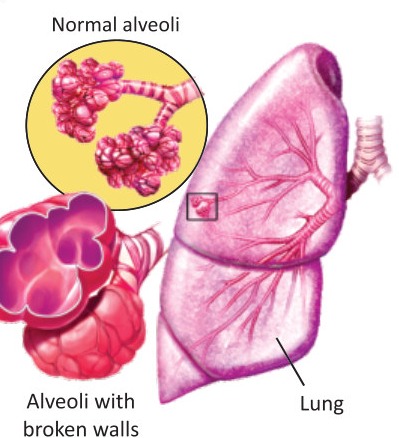 Fig 2.8: Emphysema