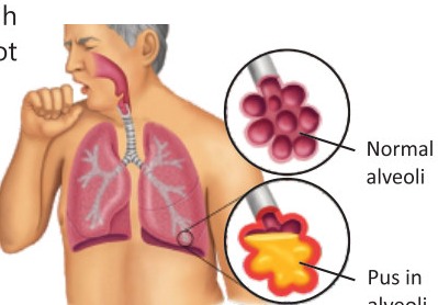 Fig 2.9: Pneumonia
