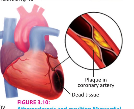 Fig 3.10: Atherosclerosis and resulting Myocardial infarction