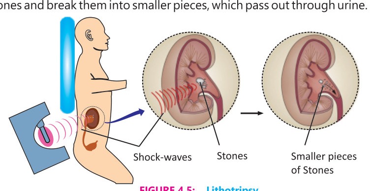 Fig 4.5: Lithotripsy