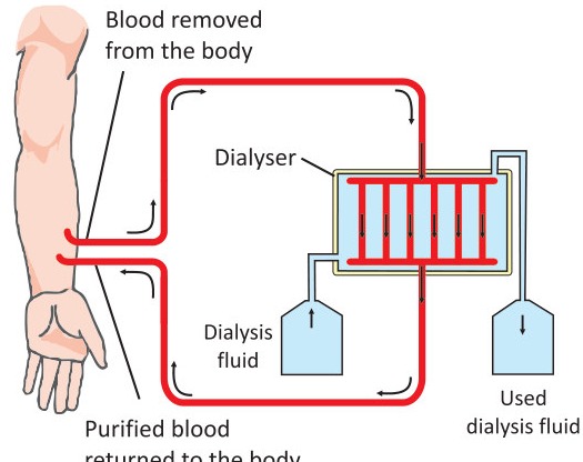 Fig 4.6: Haemodialysis