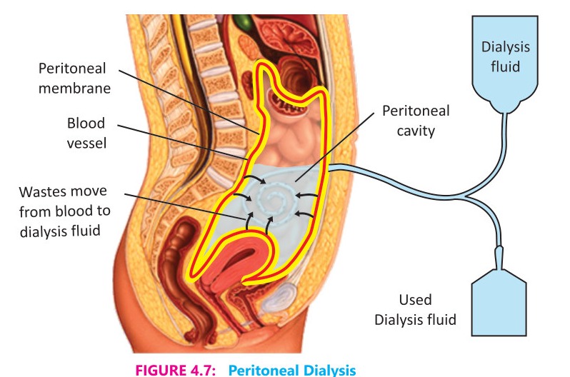 Fig 4.7: Peritoneal Dialysis