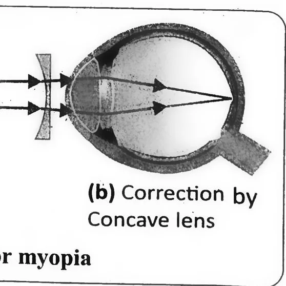 Fig 14.25: Short-sightedness or myopia