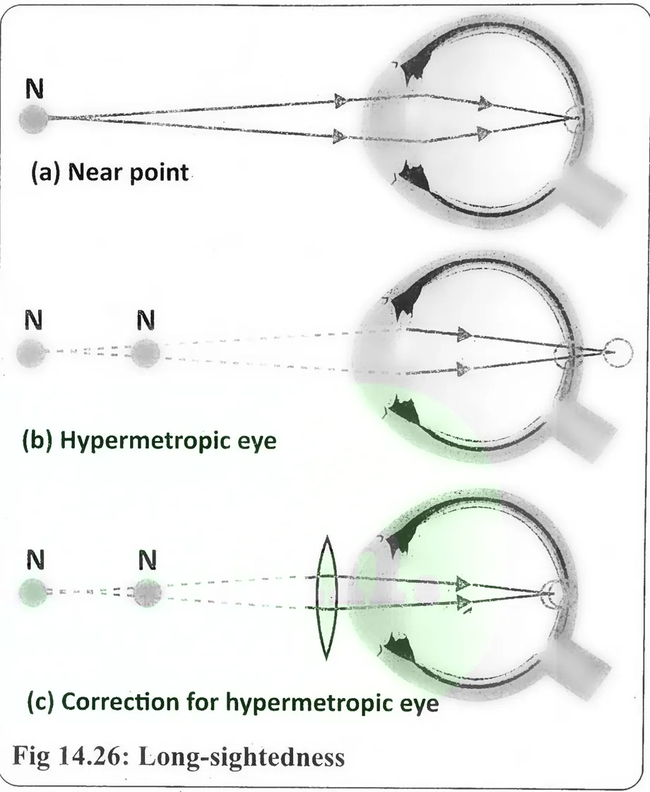 Fig 14.26: Long-sightedness